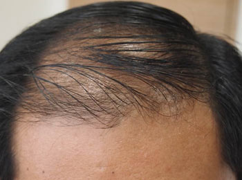 hair-loss-pic-resized