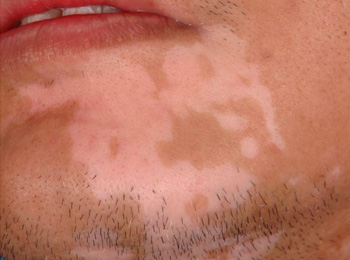 vitiligo-pic-resized